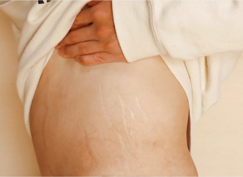Vergeture postpartum